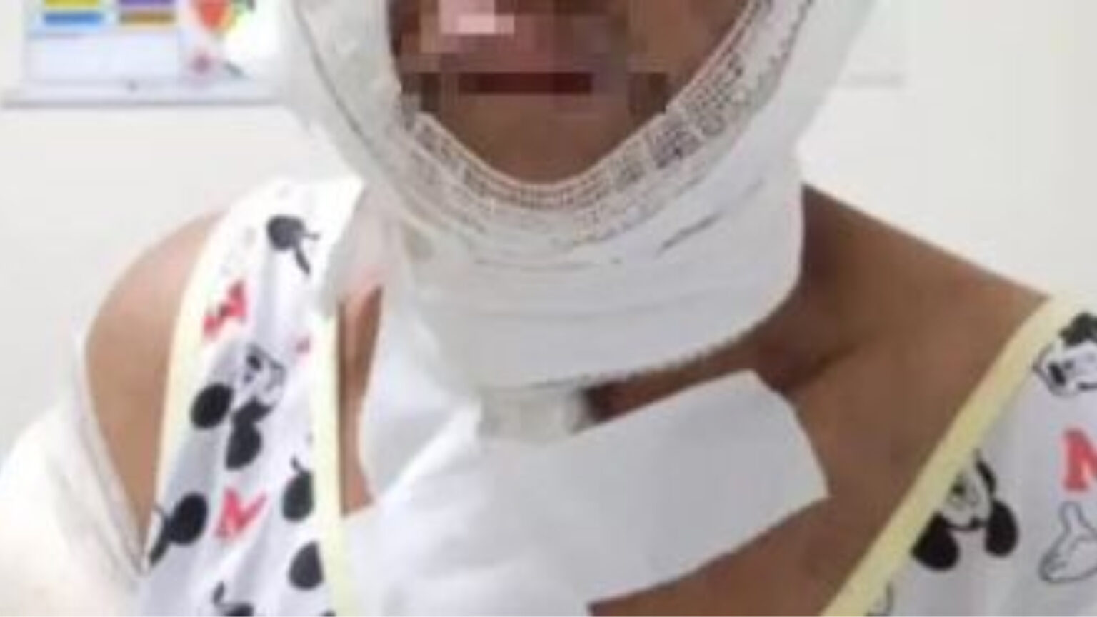 Mulher tem corpo queimado pelo companheiro no Pará