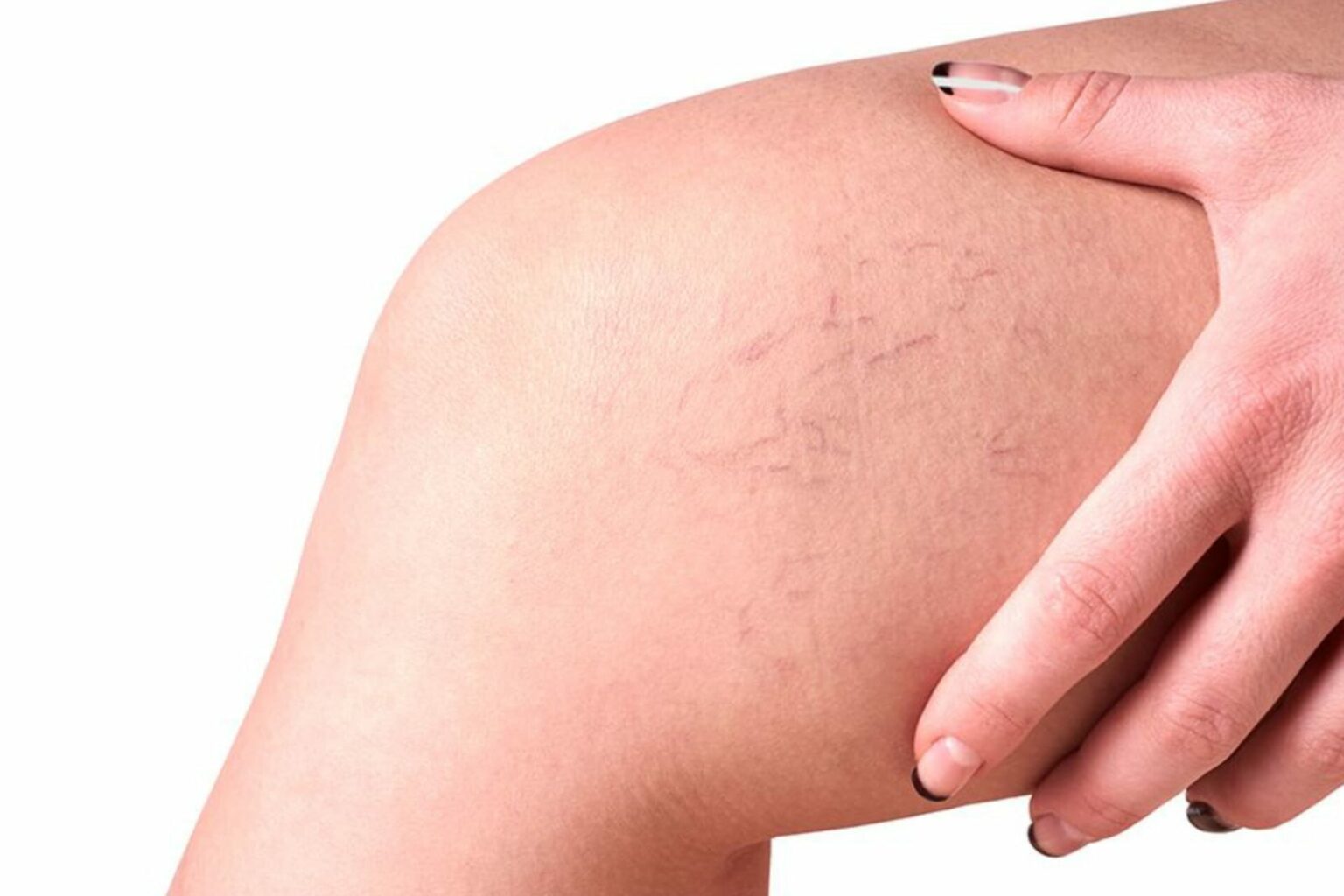 Varizes na adolescência: médica alerta sobre origens do problema