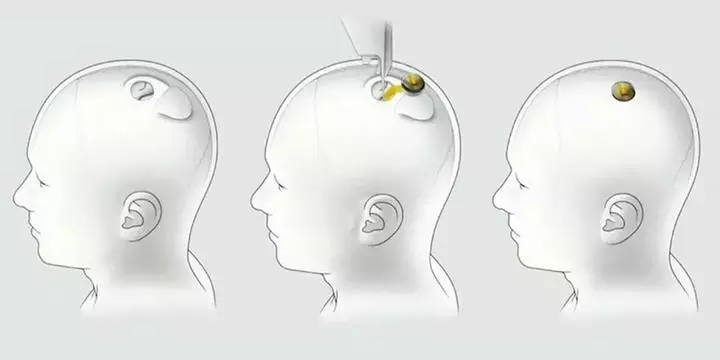 Primeiro paciente da Neuralink controla mouse com o pensamento