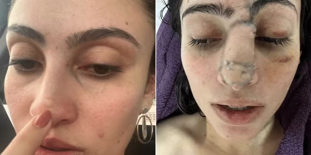 Maranhense descobre câncer raro ao tentar tirar sinal no nariz