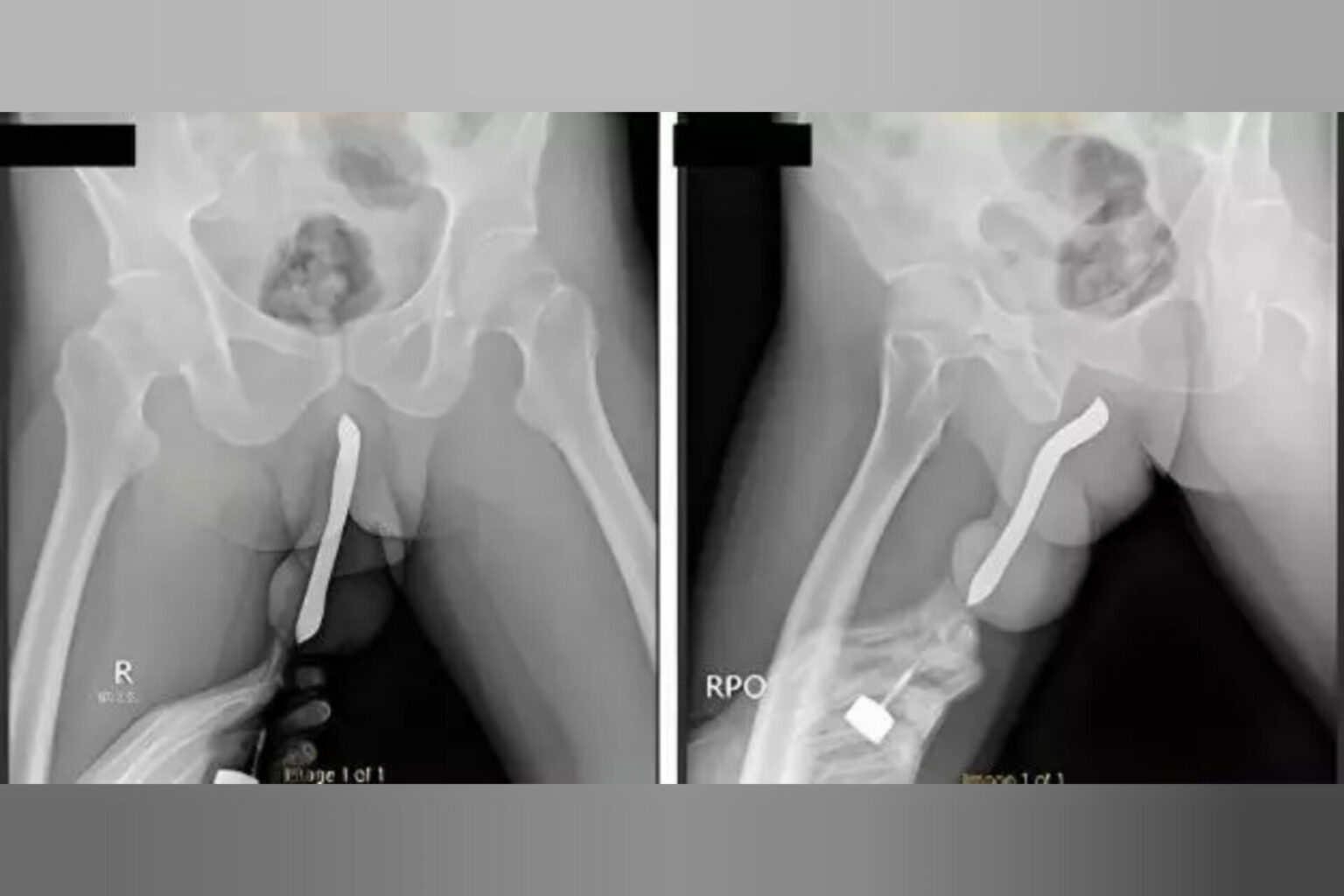 Homem coloca escova de dentes no pênis e objeto quebra durante sexo