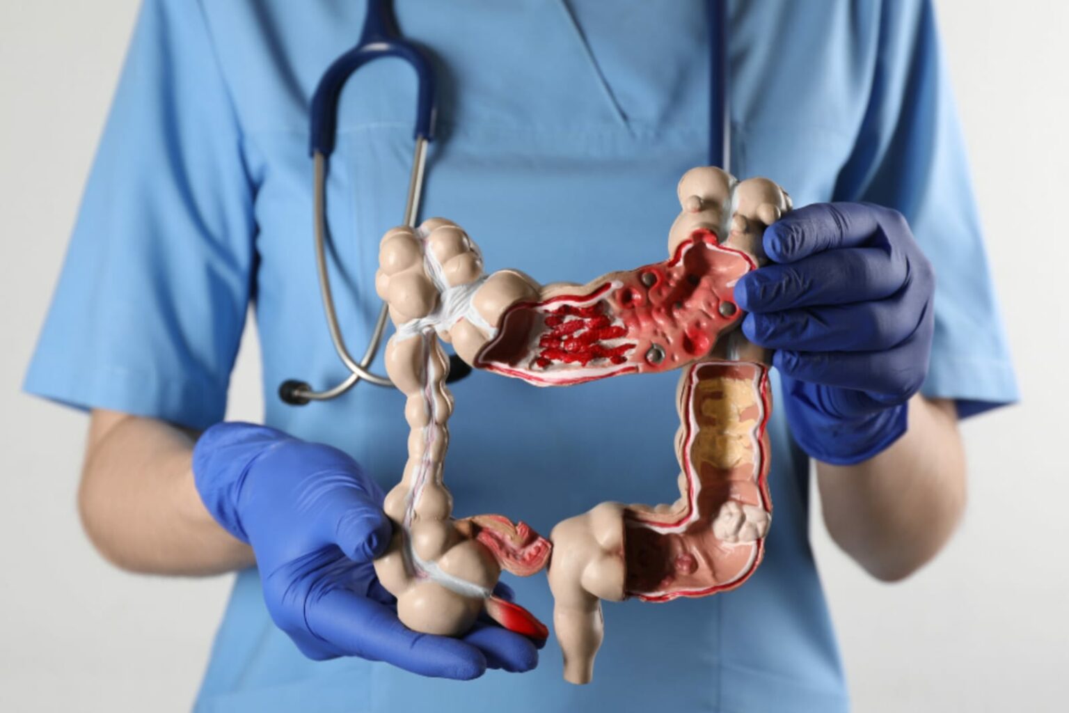 Câncer de intestino: saiba os primeiros sintomas da doença