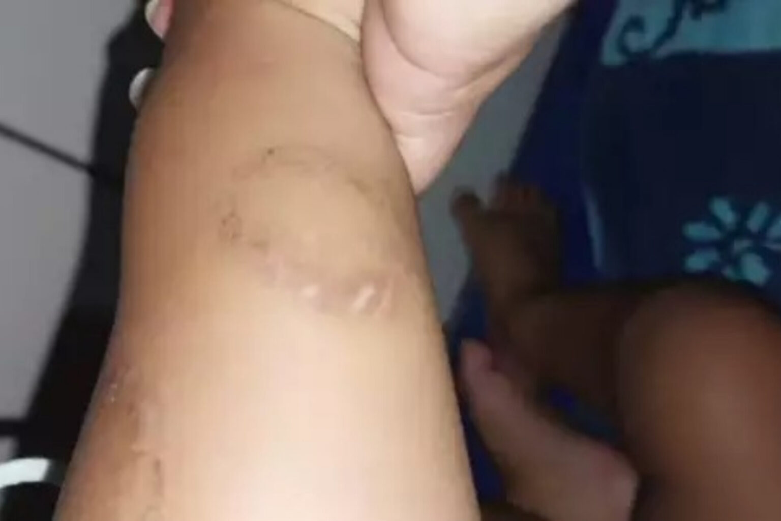 Bebê é internado com queimaduras de cigarro, mordidas e sem as unhas dos pés
