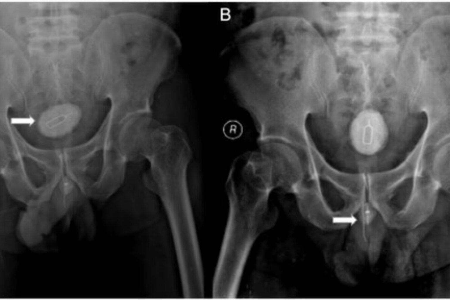 Homem passa por cirurgia após enfiar chave para retirar chip no pênis