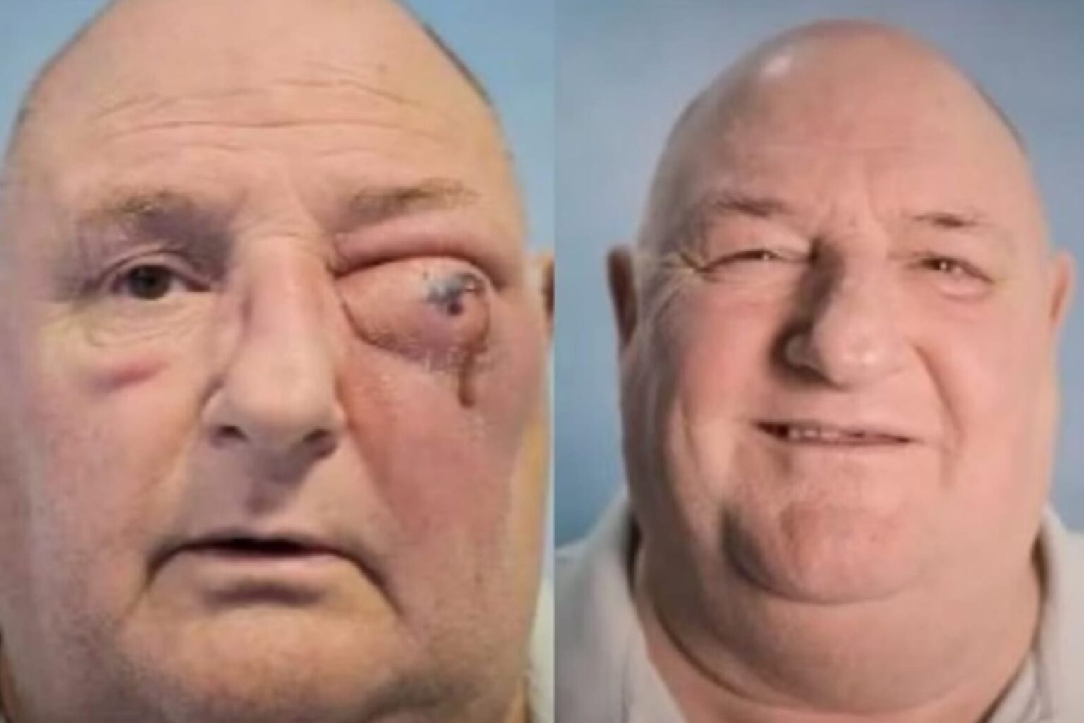 Homem contrai bactéria após infecção no dente e quase perde o olho