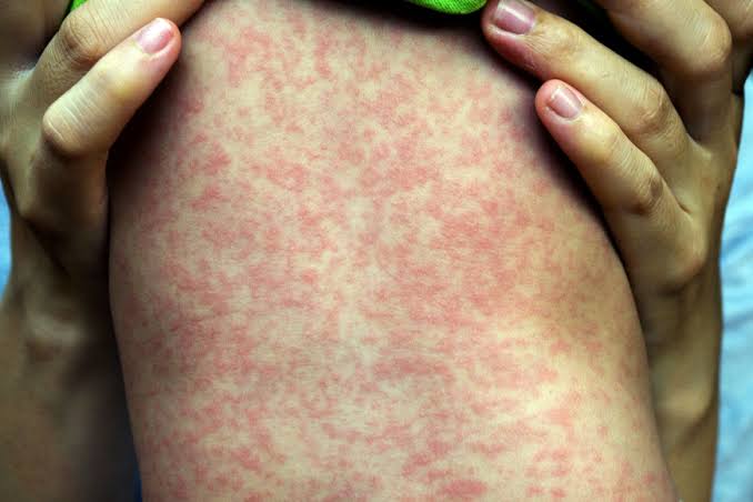 Pará completa dois anos sem registrar casos de sarampo