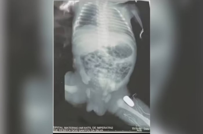 Adolescente grávida é baleada e bala fica alojada no bebê em Imperatriz
