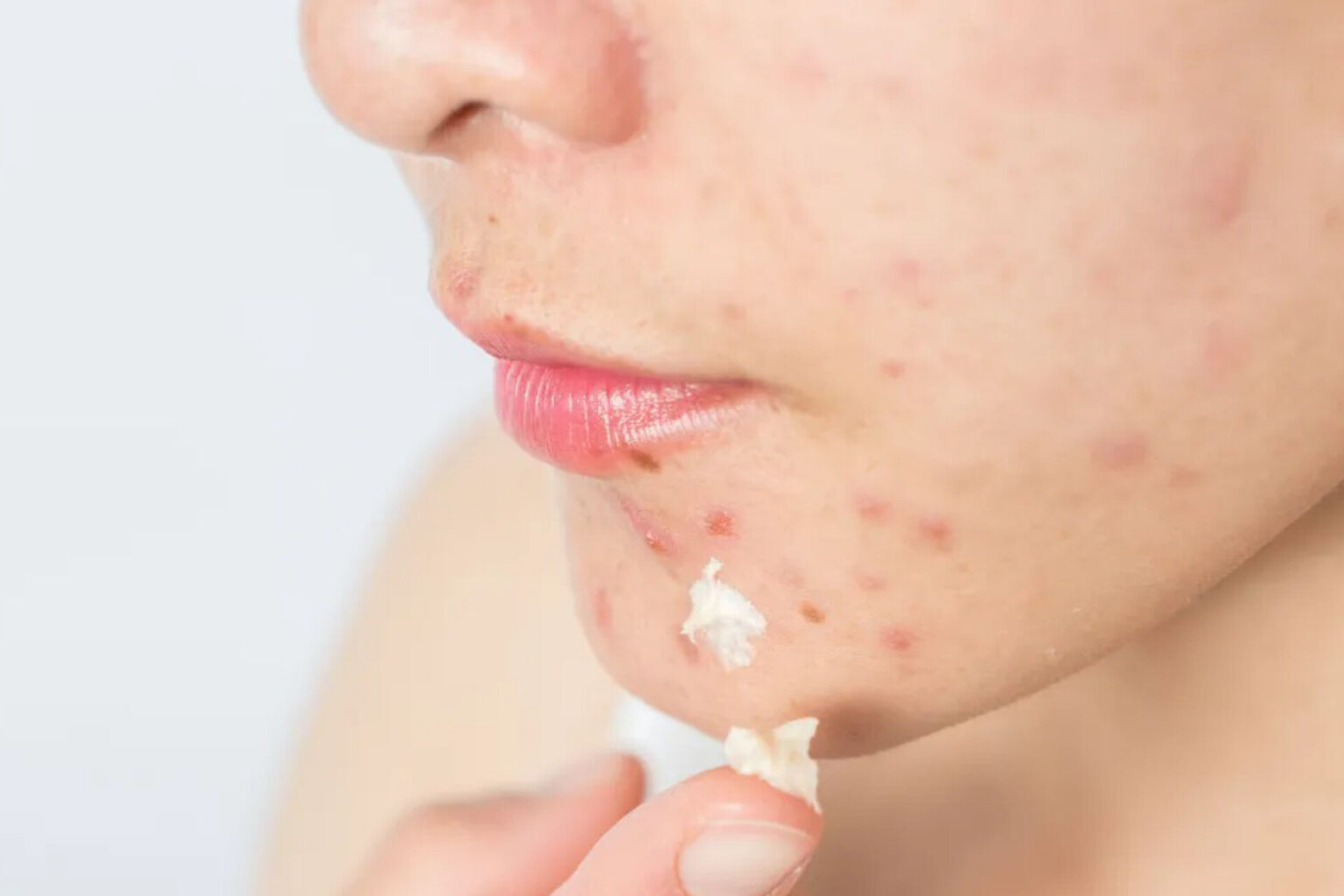 O que causa acne? Saiba como prevenir e conheça os principais tratamentos