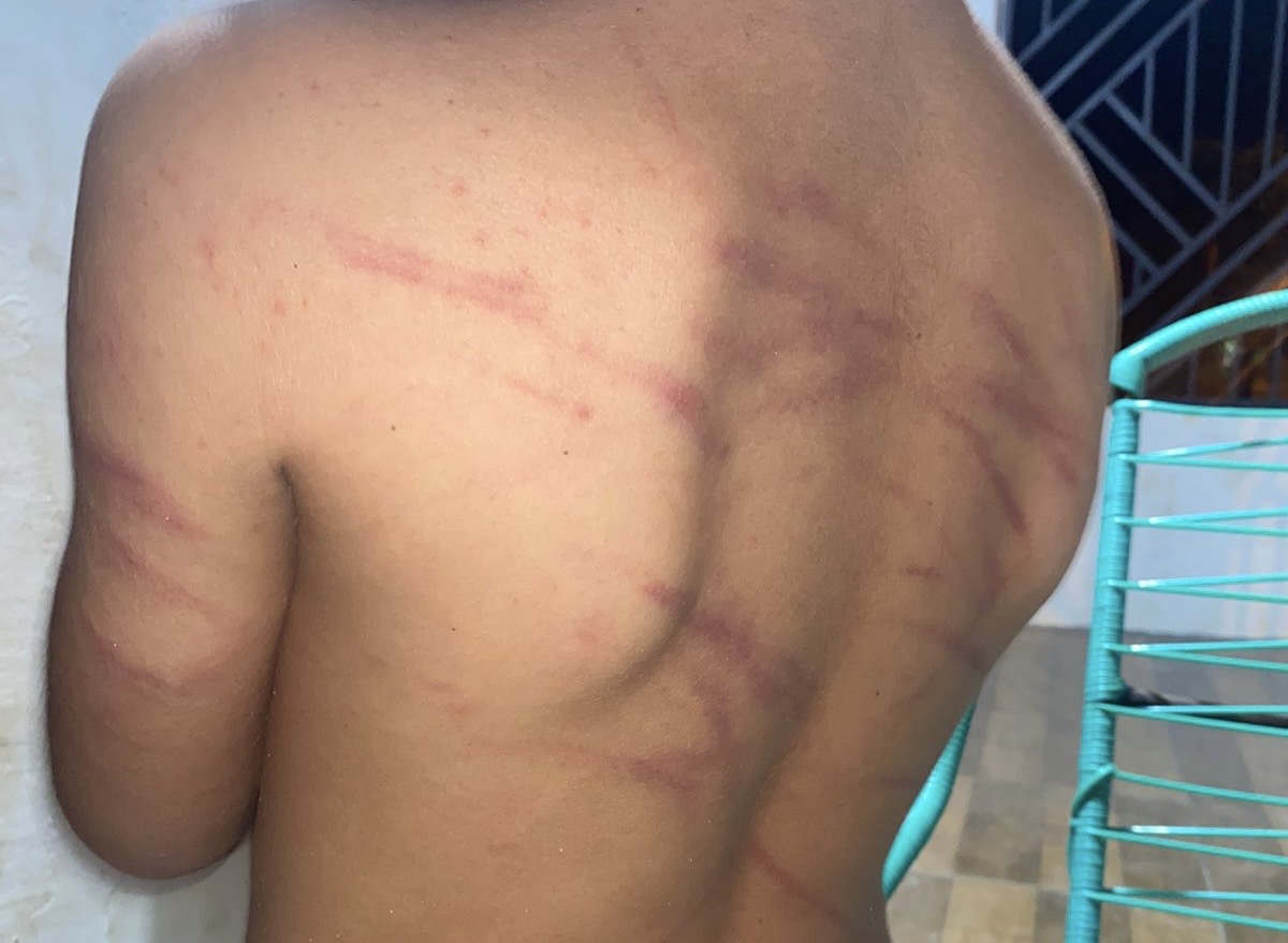 Criança fica com vários hematomas após ser agredida pela própria mãe em Marabá