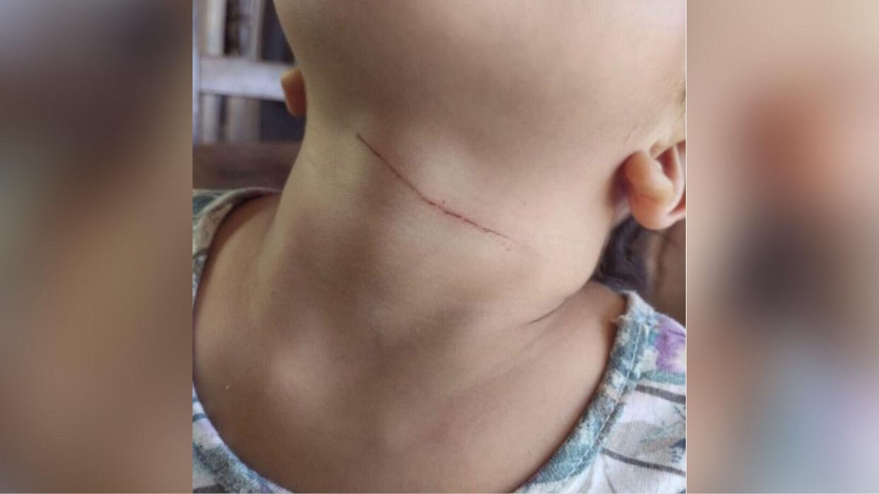 Criança de apenas 2 anos é atingida por linha de cerol no sudoeste do Pará