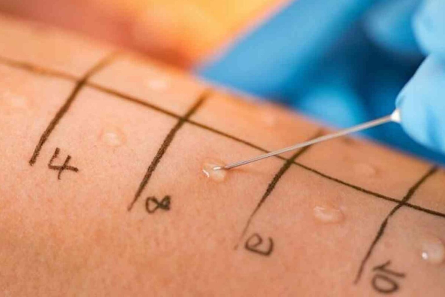 Saiba como identificar e tratar cada tipo de alergia