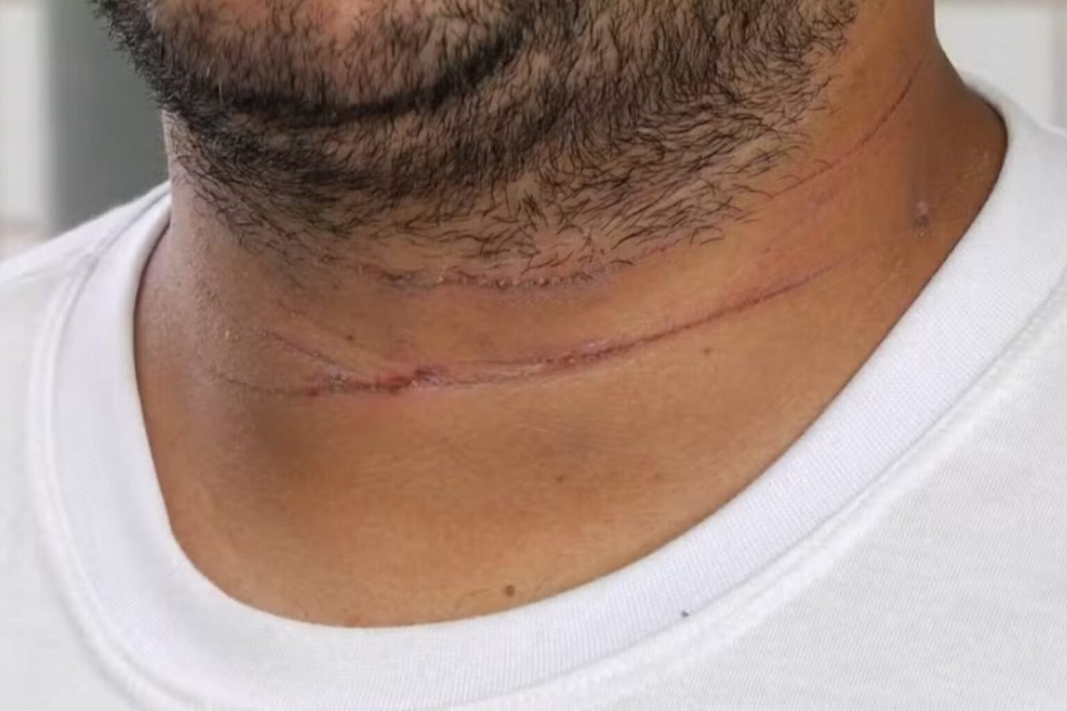 Motociclista sofre corte no pescoço ao ser atingido por linha de cerol no Pará