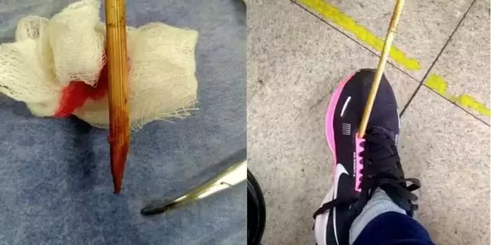 Mulher leva flechada no pé durante intervalo de trabalho