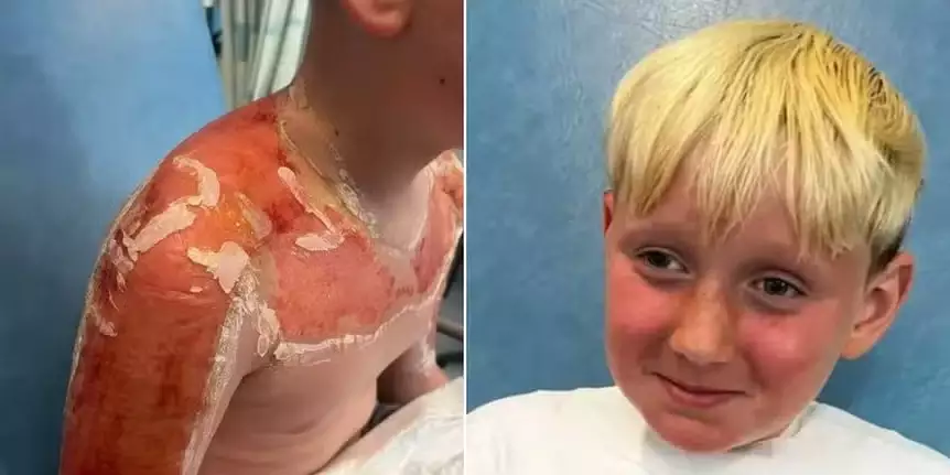 Garoto precisa de cirurgia após queimaduras causadas por protetor solar ‘vencido’
