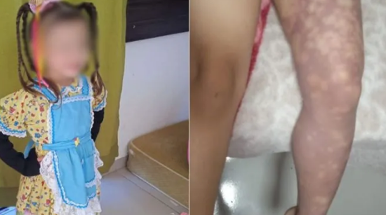 Menina de 4 anos teve perna amputada após tomar uma injeção no posto de saúde