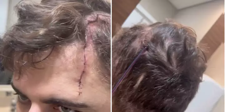 Cantor Zé Neto, dupla de Cristiano, mostra longo ferimento na cabeça após acidente com kart