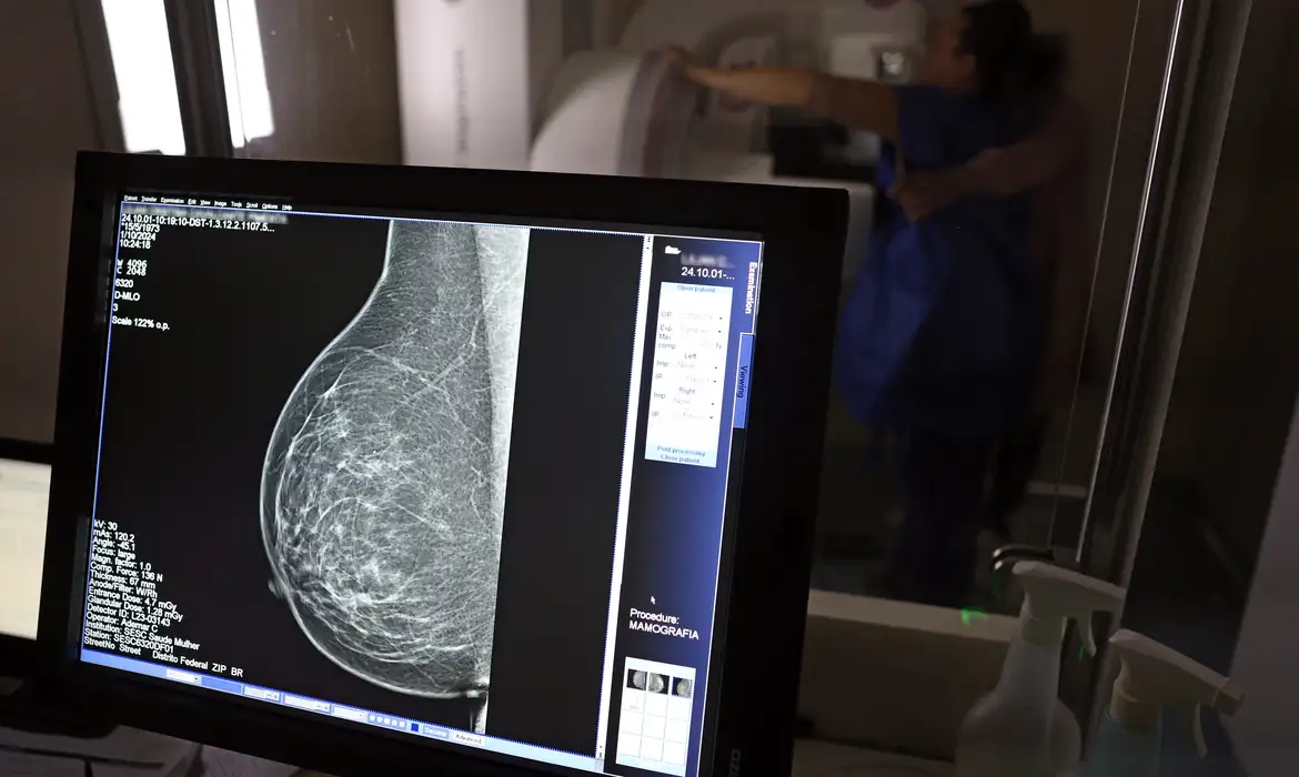 Mais de 77 mil mulheres aguardam mamografia pelo SUS