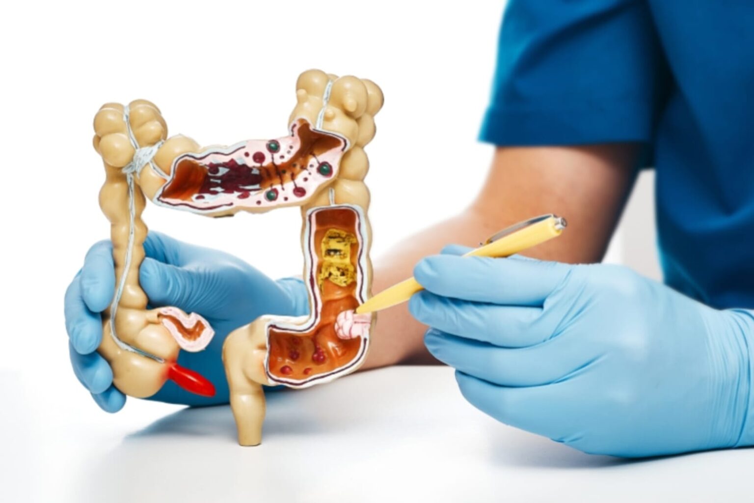 Estudos alertam para aumento de casos de câncer de intestino em jovens