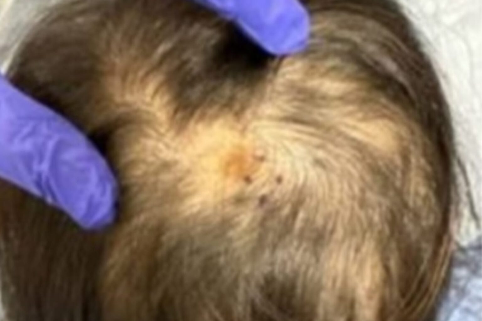 Mulher perde parte do cabelo após ser picada por carrapato