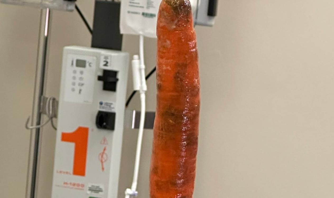 Homem passa por cirurgia para retirar cenoura de 20 cm do ânus