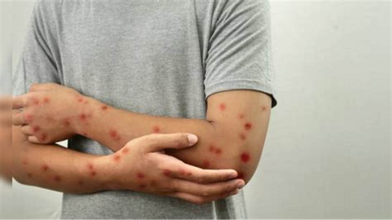 Pará já confirmou 19 casos e duas mortes de MPox em 2025, diz Sespa