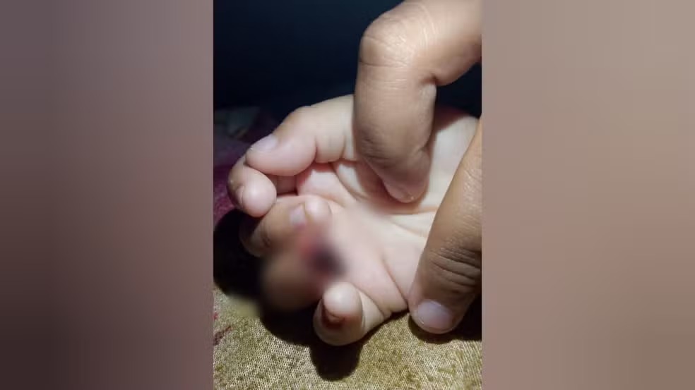 Criança de 4 anos tem parte do dedo amputada em Centro de Educação Infantil no Pará