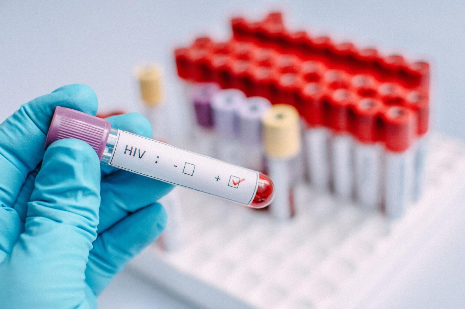 Estudo registra nova cura do HIV