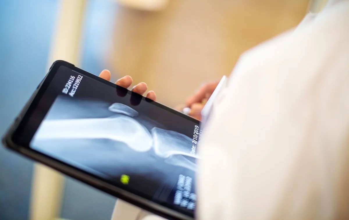 Casos de osteoporose devem disparar até 2050, inclusive no Brasil