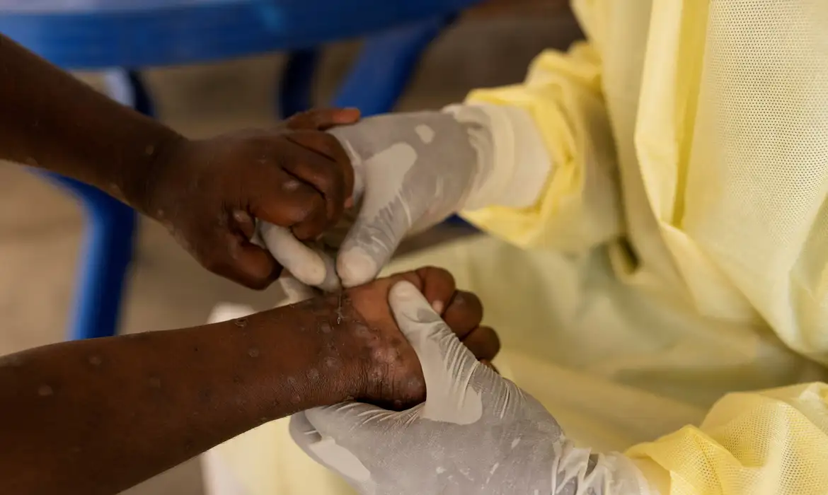 Brasil registra 88 casos de Mpox em 2026; saiba como evitar a doença