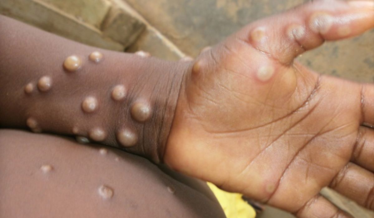 Mpox chega a 81 casos no Brasil em 2026
