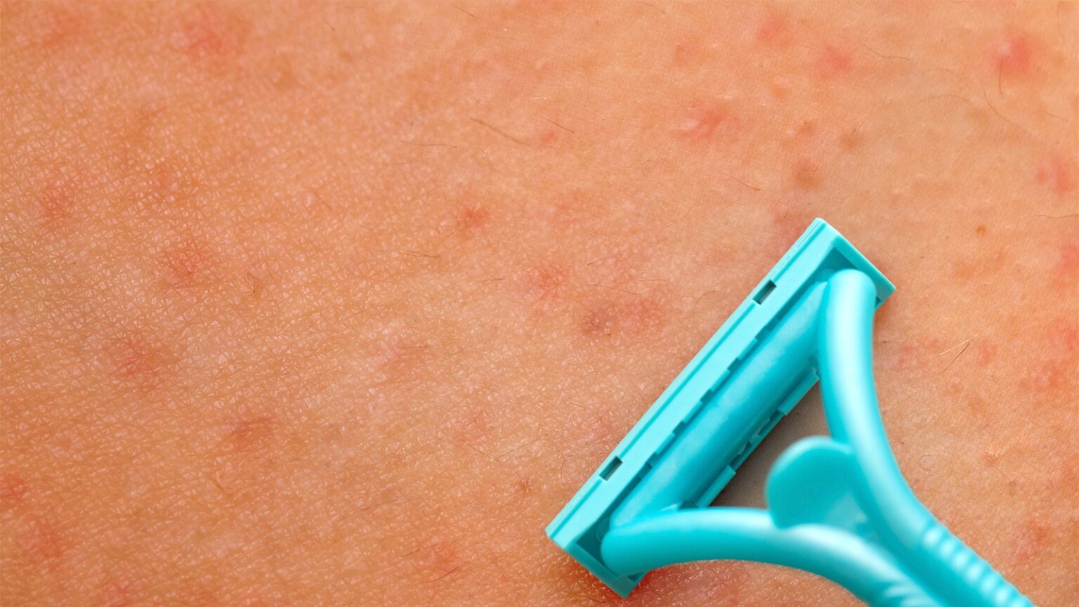Médicos alertam: raspar partes íntimas com lâmina pode ser arriscado