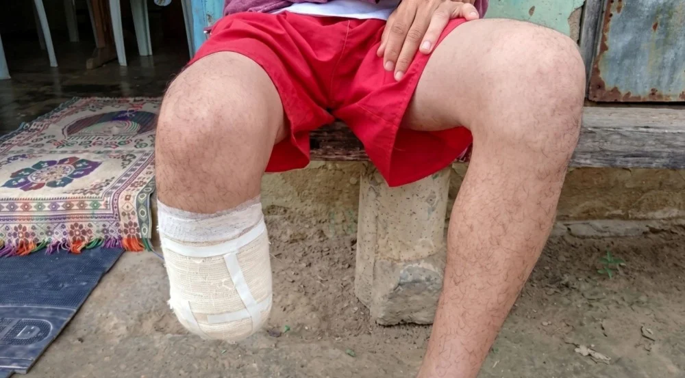 Homem que amputou o próprio pé para fraudar seguro é condenado na Bahia