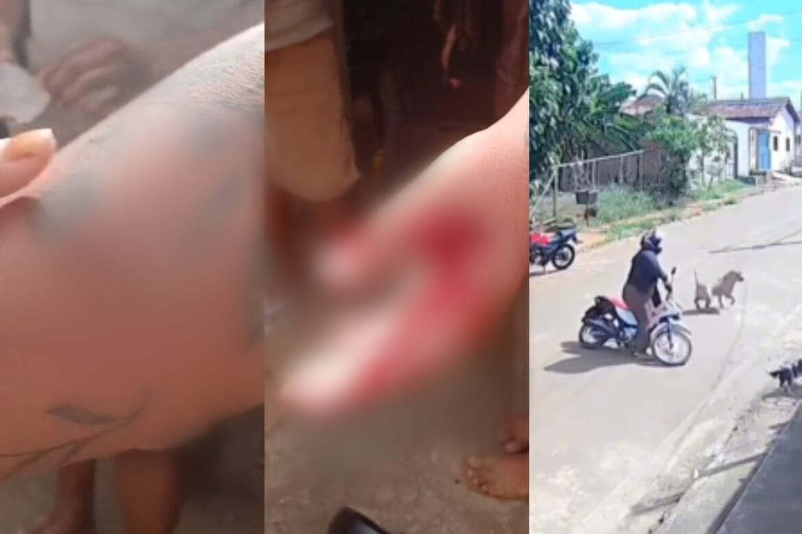Mulher é atacada por pitbull e sofre mordidas nos braços em Parauapebas