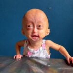 Morre Elis Lima Carneiro aos 5 anos, influencer mirim com síndrome rara de envelhecimento precoce