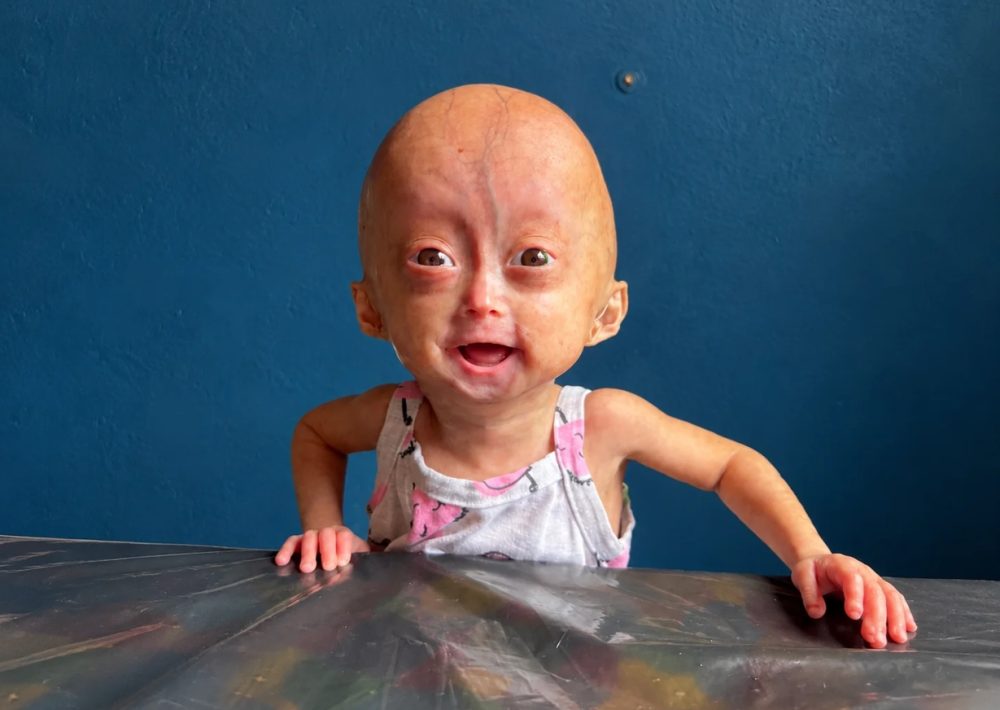 Morre Elis Lima Carneiro aos 5 anos, influencer mirim com síndrome rara de envelhecimento precoce