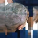 Larvas na cabeça: pais são presos por suspeita de maus-tratos e negligência
