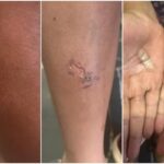 Pai tortura e queima filhas de 11 e 12 anos com pegador de carvão