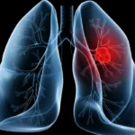 Saiba o que é adenocarcinoma pulmonar, câncer que atinge o papa